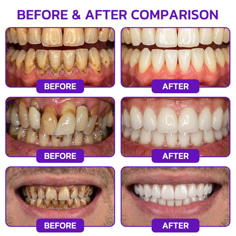 Purelora® VioCore Bee Venom Gingivitis & Periodontitis Treatment Toothpaste