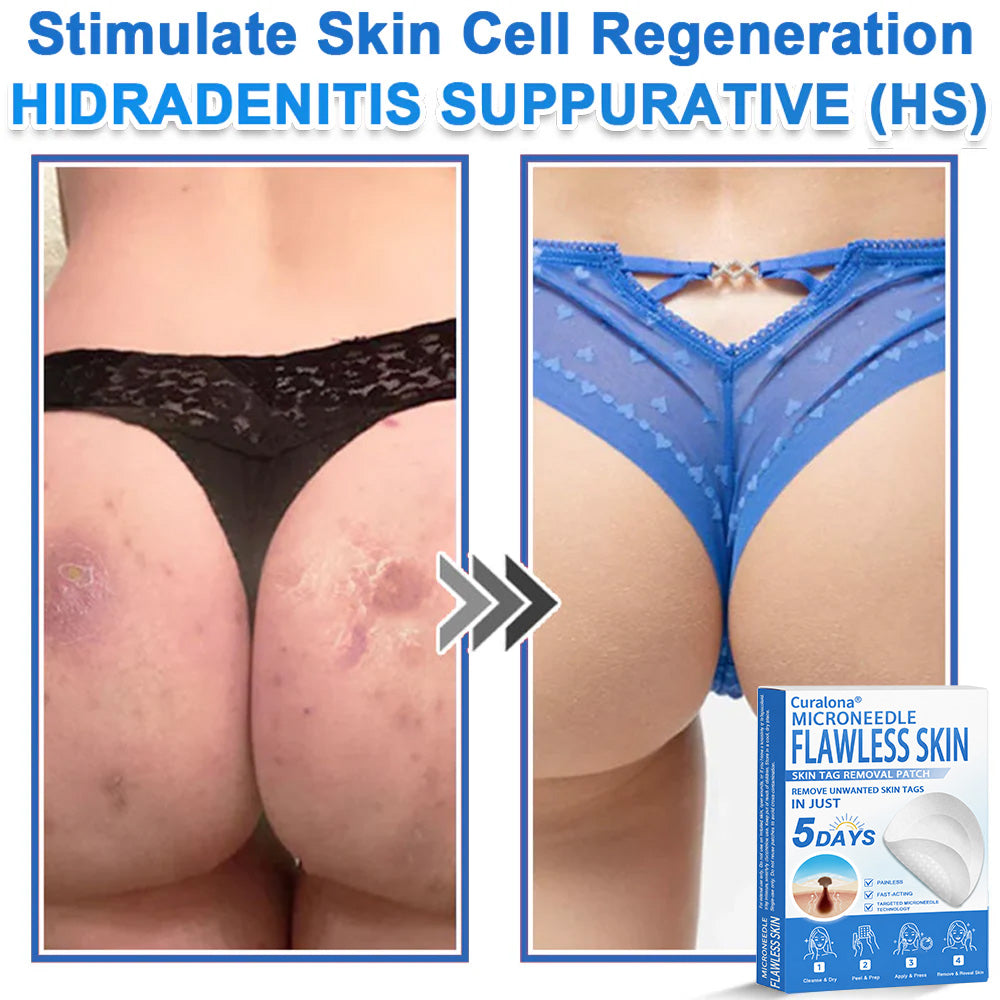 🔥 Curalona® 2-in-1 Microneedle & Hydrocolloid Patch | Raised Moles,Acne,  Flat Warts & Skin Tags Remover | Improves Wrinkles, Scars & Blemishes | Invisible Pimple Patches for Face & Body