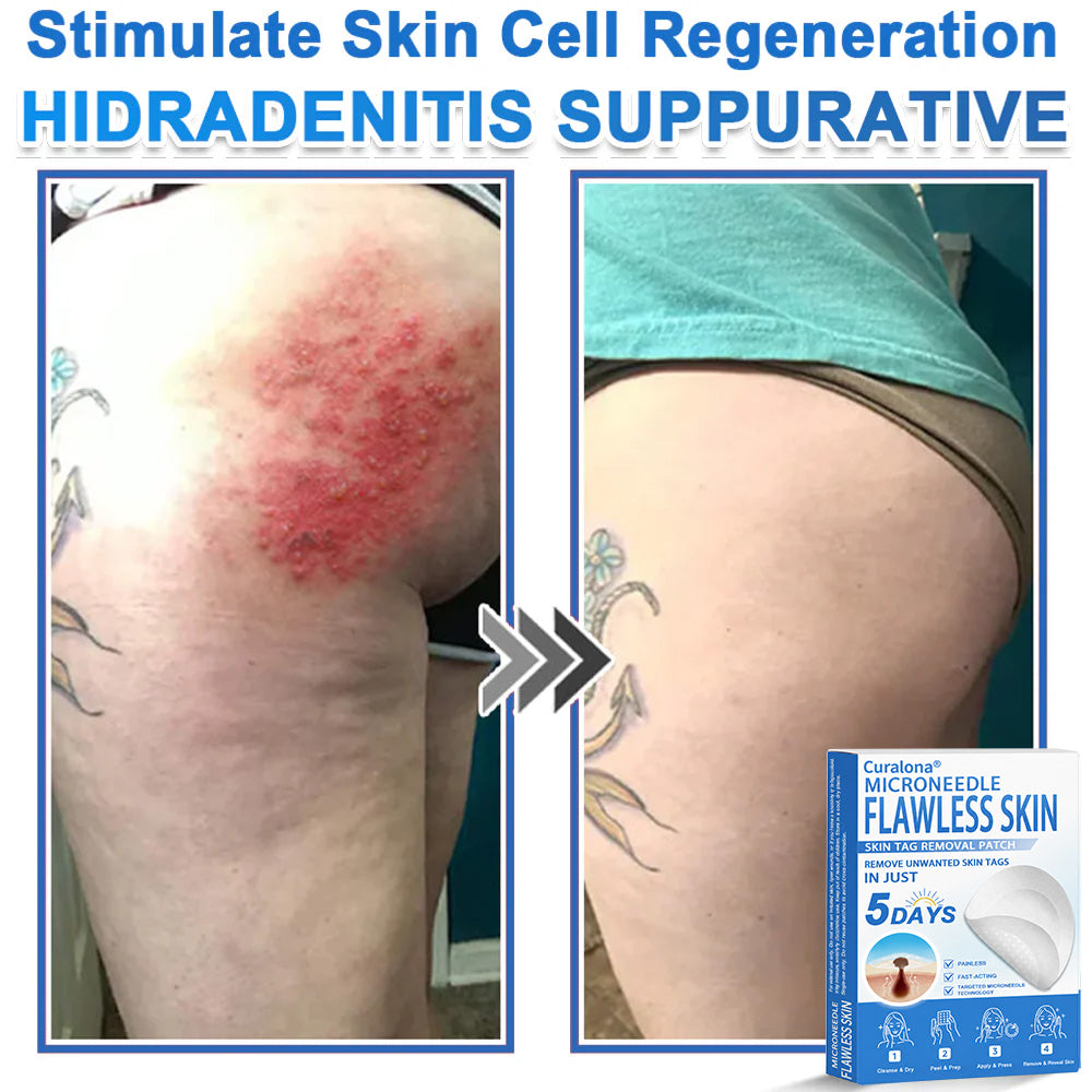 🔥 Curalona® 2-in-1 Microneedle & Hydrocolloid Patch | Raised Moles,Acne,  Flat Warts & Skin Tags Remover | Improves Wrinkles, Scars & Blemishes | Invisible Pimple Patches for Face & Body
