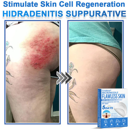 🔥 Curalona® 2-in-1 Microneedle & Hydrocolloid Patch | Raised Moles,Acne,  Flat Warts & Skin Tags Remover | Improves Wrinkles, Scars & Blemishes | Invisible Pimple Patches for Face & Body