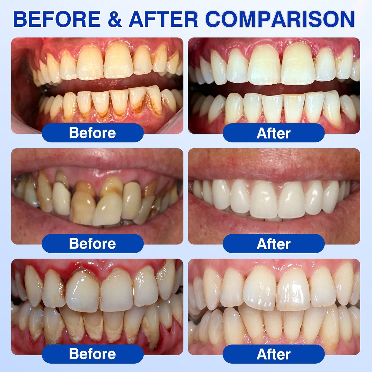 🏅🦷🛡️Purelora® GumRevive Periodontal Repair Gel