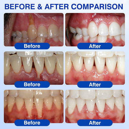 🏅🦷🛡️Purelora® GumRevive Periodontal Repair Gel