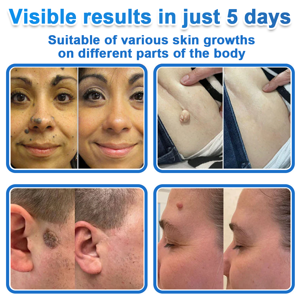 🔥 Curalona® 2-in-1 Microneedle & Hydrocolloid Patch | Raised Moles,Acne,  Flat Warts & Skin Tags Remover | Improves Wrinkles, Scars & Blemishes | Invisible Pimple Patches for Face & Body