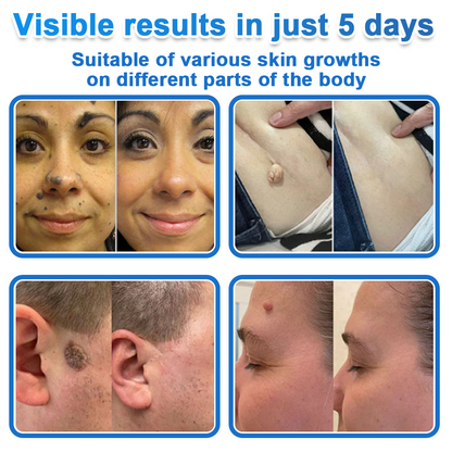 🔥 Curalona® 2-in-1 Microneedle & Hydrocolloid Patch | Raised Moles,Acne,  Flat Warts & Skin Tags Remover | Improves Wrinkles, Scars & Blemishes | Invisible Pimple Patches for Face & Body