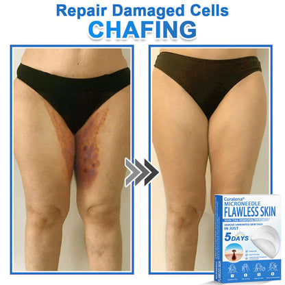 🔥 Curalona® 2-in-1 Microneedle & Hydrocolloid Patch | Raised Moles,Acne,  Flat Warts & Skin Tags Remover | Improves Wrinkles, Scars & Blemishes | Invisible Pimple Patches for Face & Body