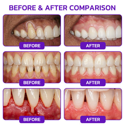 Purelora® VioCore Bee Venom Gingivitis & Periodontitis Treatment Toothpaste