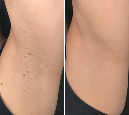 🔥Curalona®2-in-1 Microneedle & Hydrocolloid Patch🍀| Removes Raised Moles, Acne, Flat Warts & Skin Tags | Helps Improve Wrinkles, Scars & Blemishes | Invisible Patches for Face & Body