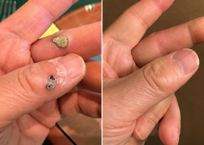 🔥Curalona®2-in-1 Microneedle & Hydrocolloid Patch🍀| Removes Raised Moles, Acne, Flat Warts & Skin Tags | Helps Improve Wrinkles, Scars & Blemishes | Invisible Patches for Face & Body